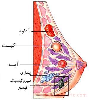 اطلاعاتی درباره سرطان سینه